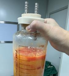 龙口水动力吸脂手术要做多久？